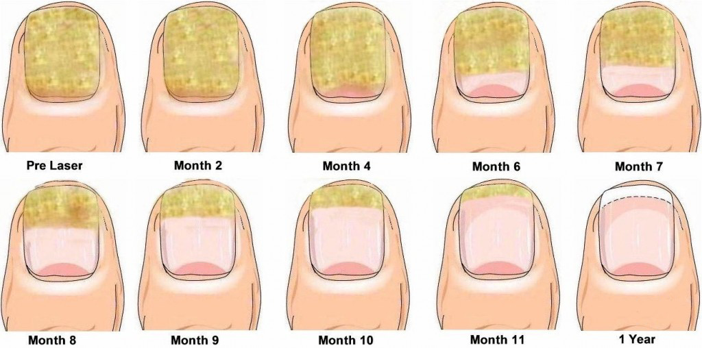 The Top 5 Reasons Why People Get Fungal Nail Infections